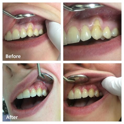 periodontal procedure for too high gums.